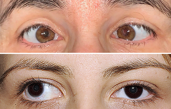 استرابیسم یا انحراف چشم